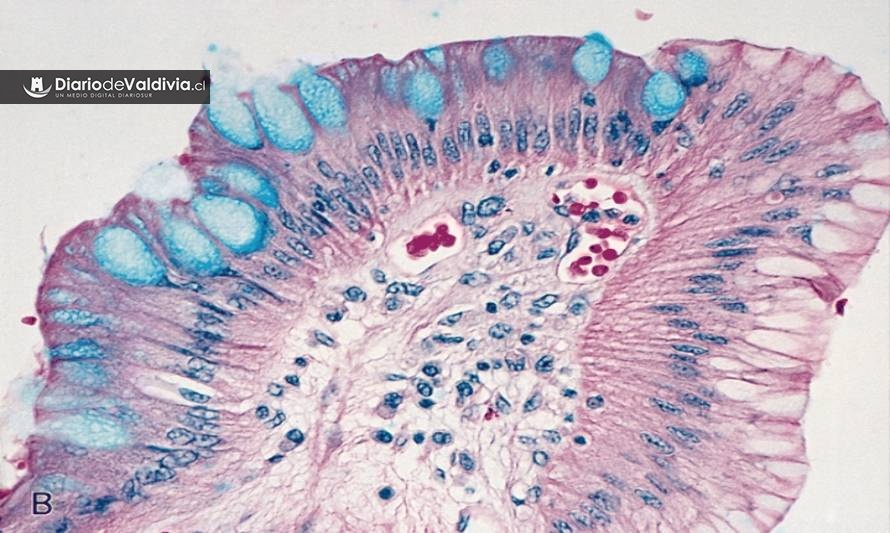 Gastroenterólogos advierten sobre la importancia de un oportuno diagnóstico de esófago de Barret